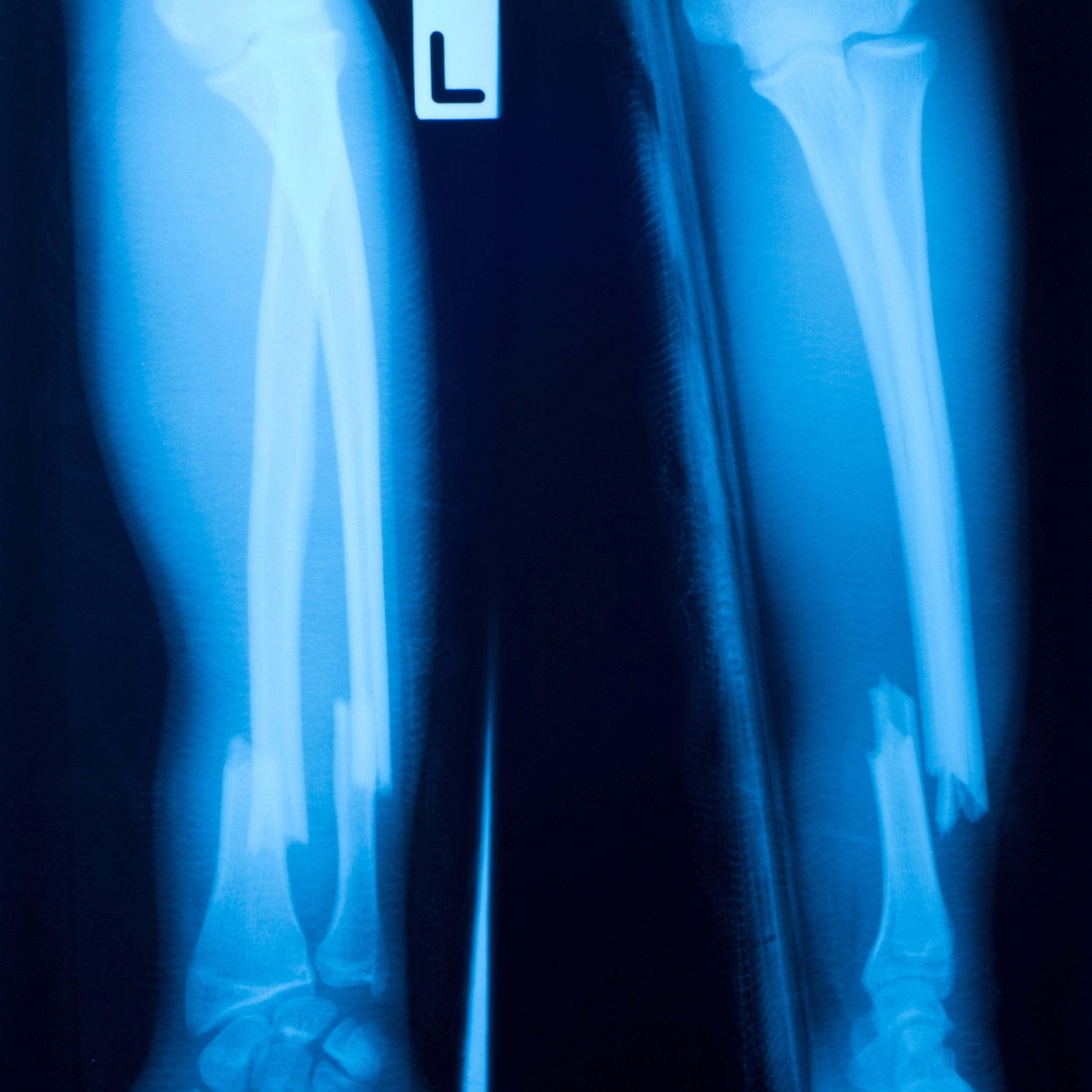 Osteoporosis-x-ray