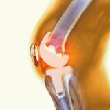 Knee-Prosthesis